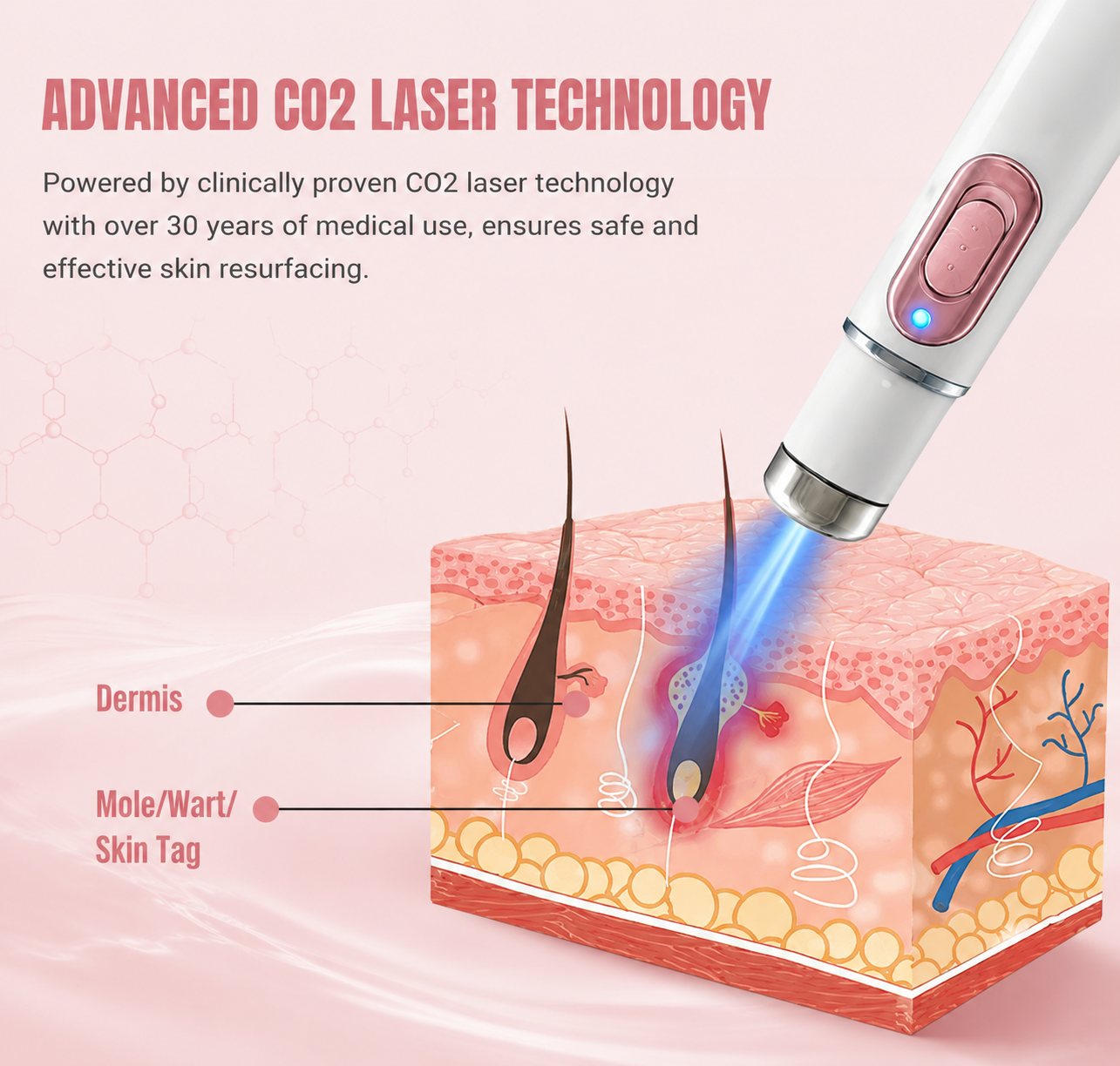 Mole & Wart Removal Laser Pen